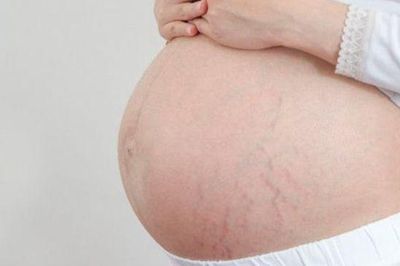 3 nguyên tắc giúp hạn chế rạn da khi mang thai