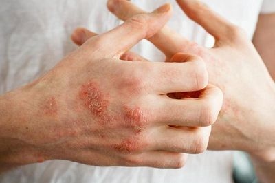 Căn bệnh không lây bùng phát dữ dội, gây 'bão viêm' toàn thân
