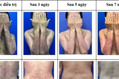 Điều trị thành công ca vảy nến thể mủ toàn thân nặng bằng thuốc sinh học mới