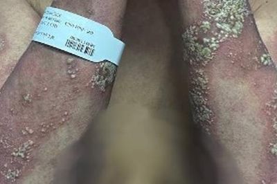 Da tổn thương toàn thân vì đợt bùng phát vảy nến hiếm gặp