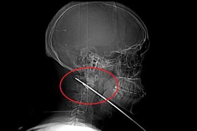 Nhập viện vì đau bất thường, nam bệnh nhân 27 tuổi khiến bác sĩ 'sốc' khi lấy ra thứ không ngờ tới