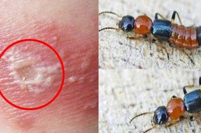 Bác sĩ chỉ cách phân biệt viêm da do kiến ba khoang và zona thần kinh