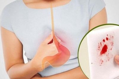 Người phụ nữ 63 tuổi phát hiện ung thư dạ dày từ dấu hiệu nhiều người Việt thường bỏ qua