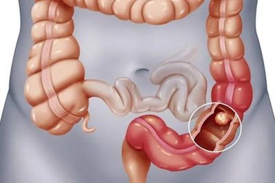 Người thân mắc ung thư tiêu hóa: Gia đình cần làm gì?
