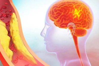 5 dấu hiệu cảnh báo thiếu máu não do hẹp động mạch cảnh