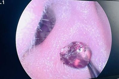 Đau tai đi khám, bệnh nhân hốt hoảng vì sinh vật ký sinh ẩn nấp