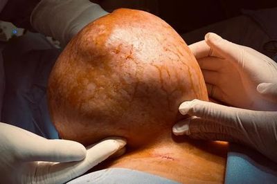 Mang 'quả tạ' gần 4kg suốt nhiều năm, người phụ nữ bàng hoàng khi biết sự thật