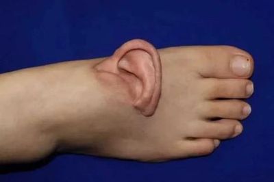 Người phụ nữ 'mọc' tai trên bàn chân và sự thật bất ngờ