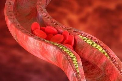 Thay đổi lối sống giúp kiểm soát cholesterol cao, giảm nguy cơ bệnh tim mạch