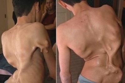 Bé gái ở TP.HCM mắc hội chứng 'người hóa đá', triệu người có một ca