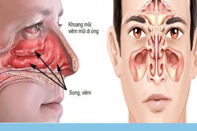 Thời tiết hè thất thường: Coi chừng nhầm lẫn giữa viêm mũi dị ứng và viêm xoang