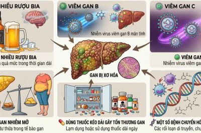 Chăm sóc người bệnh xơ gan tại nhà đúng cách để tránh biến chứng nguy hiểm