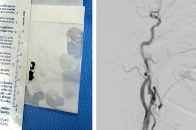 Bệnh viện Trường Đại học Y - Dược Huế cứu sống ca nhồi máu hiếm gặp