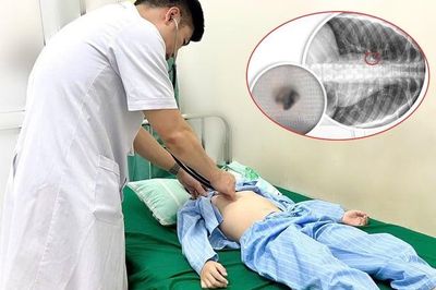 Nhổ răng tại nhà, bé trai suýt ngạt thở vì chiếc răng rơi vào phổi