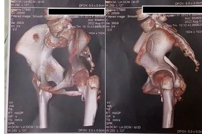 Phát hiện ca bệnh hội chứng người hóa đá hiếm gặp ở trẻ em