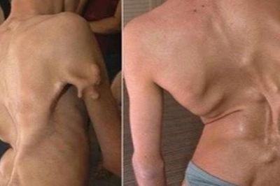 Bé gái 12 tuổi mắc hội chứng 'người hóa đá' cực hiếm, cả triệu người mới có một ca