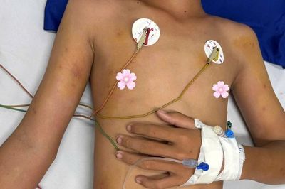 Cứu sống bệnh nhi Cà Mau bị ong vò vẽ đốt hơn 50 vết