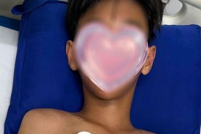 Bé trai ở Cà Mau bị ong vò vẽ đốt hơn 50 vết