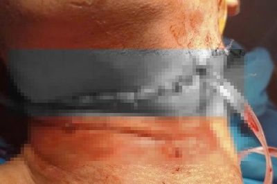 Cứu nam thanh niên bị rách sâu vùng cổ do tai nạn giao thông