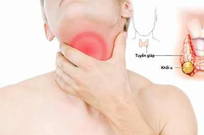 Nhận diện sớm ung thư tuyến giáp để bảo vệ sức khỏe lâu dài