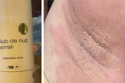 Nổi mề đay, đau nhức vùng nách rồi lan khắp cơ thể sau khi dùng lăn khử mùi 'hàng Nhật' xách tay
