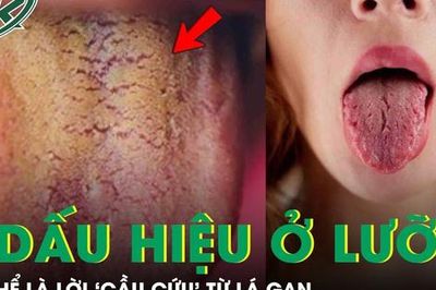 Đừng bỏ qua 3 dấu hiệu bất thường này trên lưỡi, có thể là lời 'cầu cứu' từ lá gan