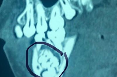 Loại bỏ gần 50 cái răng trong khối u vùng hàm cho bệnh nhi 13 tuổi