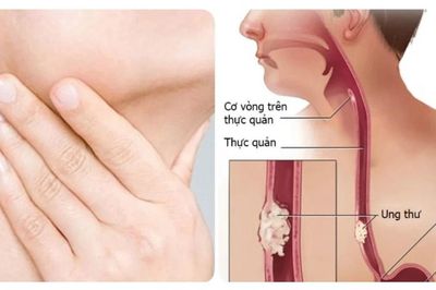 Người đàn ông phát hiện mắc ung thư thực quản thừa nhận 2 sai lầm nhiều người Việt mắc phải