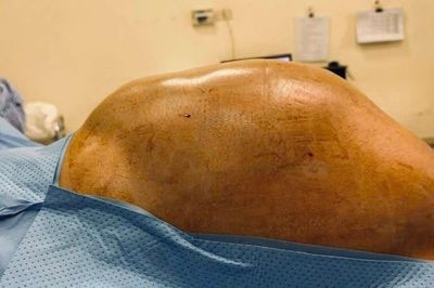 Thiếu nữ 16 tuổi mang khối u buồng trứng gần 15kg: Bác sĩ khuyến cáo không chủ quan với dấu hiệu bất thường