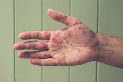 Nhiều bệnh tăng mạnh, TP.HCM cảnh báo 'sóng dịch'