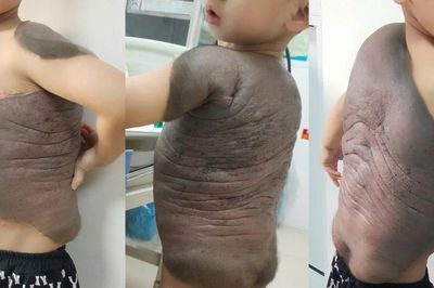 Bé trai mang 'mai rùa' suốt 7 năm lần đầu đứng thẳng