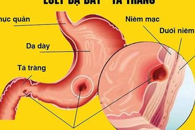 Những nguy cơ khi tự ý dùng meloxicam trị đau xương khớp