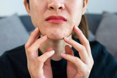Nhiều người uống kẽm trị mụn nhưng mắc sai lầm này: Càng dùng càng hại sức khỏe