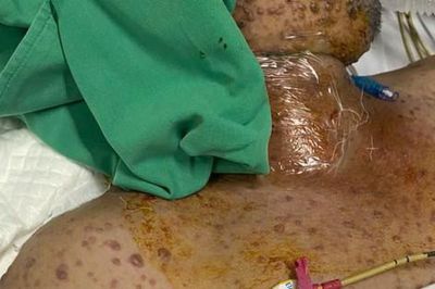 Nam bệnh nhân 32 tuổi bị biến chứng thủy đậu phải thở máy kéo dài