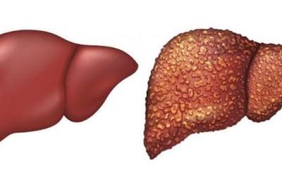 Phát hiện bệnh xơ gan qua các dấu hiệu sớm