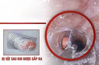 Bệnh viện Đa khoa Ninh Thuận kịp thời gắp viên thuốc còn vỉ bọc trong thực quản bệnh nhi