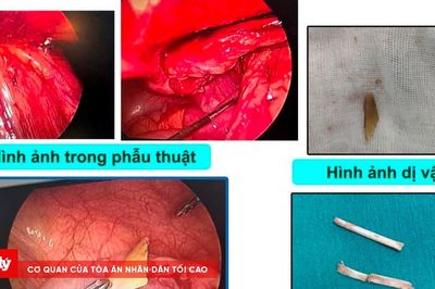 Trẻ 48 tháng tuổi bị xương lợn đâm thủng ruột