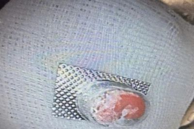 Bé trai 12 tuổi suýt thủng thực quản vì nuốt viên thuốc còn nguyên vỉ sắc nhọn
