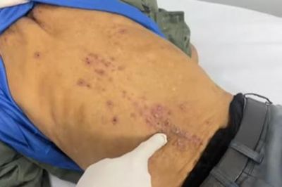 Người đàn ông phát hiện mắc cùng lúc hai loại ký sinh trùng