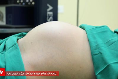Người phụ nữ mang khối u xơ tử cung nặng gần 5kg