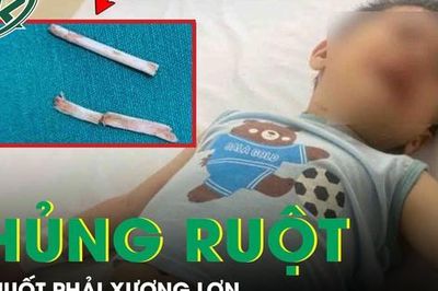 Hai trẻ bị thủng ruột, viêm phúc mạc do nuốt phải xương lợn