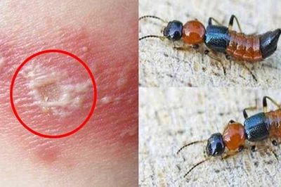 5 bước xử lý đúng cách khi tiếp xúc với kiến 3 khoang
