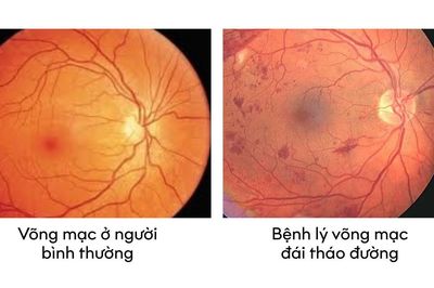 Bệnh võng mạc đái tháo đường - chủ quan có thể dẫn đến biến chứng mù lòa