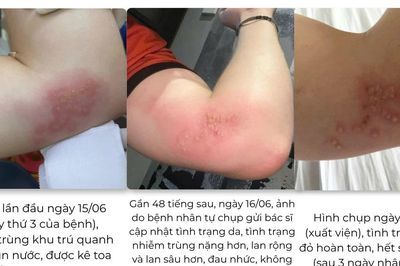 Không chủ quan với biến chứng zona chỉ sau 48 giờ