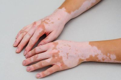Ngày Bạch biến Thế giới 25/6: Nam và nữ đều có thể mắc, dù ở bất kỳ tuổi nào