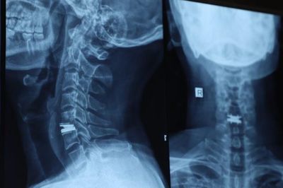 Người đàn ông 43 tuổi đau cổ, tê tay suốt 2 năm vì bệnh lý nhiều người Việt dễ bỏ qua