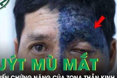 Người đàn ông 54 tuổi suýt mù mắt do biến chứng nặng của zona thần kinh