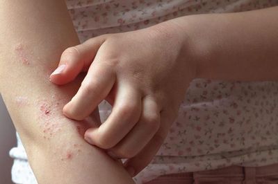Dấu hiệu ngứa do ký sinh trùng