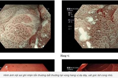 Phát hiện sớm ung thư dạ dày, người đàn ông 76 tuổi không cần hóa trị