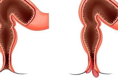 Sa trực tràng ở trẻ em có nguy hiểm?